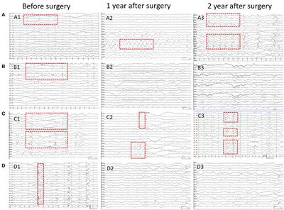 Interictal Discharge Pattern in Preschool-Aged Children With Tuberous Sclerosis Complex Before and After Resective Epilepsy Surgery